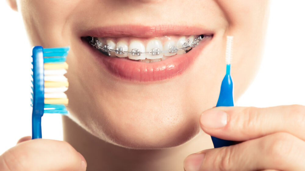 Μπορούν τα σιδεράκια να διορθώσουν τυχόν δόντια;