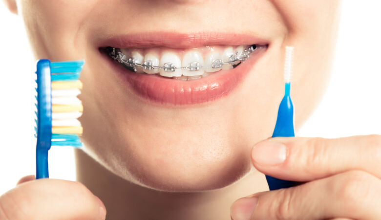 Μπορούν τα σιδεράκια να διορθώσουν τυχόν δόντια;