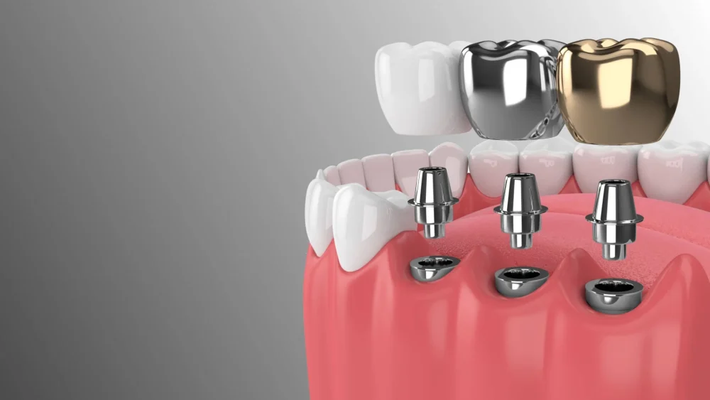 Πόσο διαρκούν τα οδοντικά εμφυτεύματα;