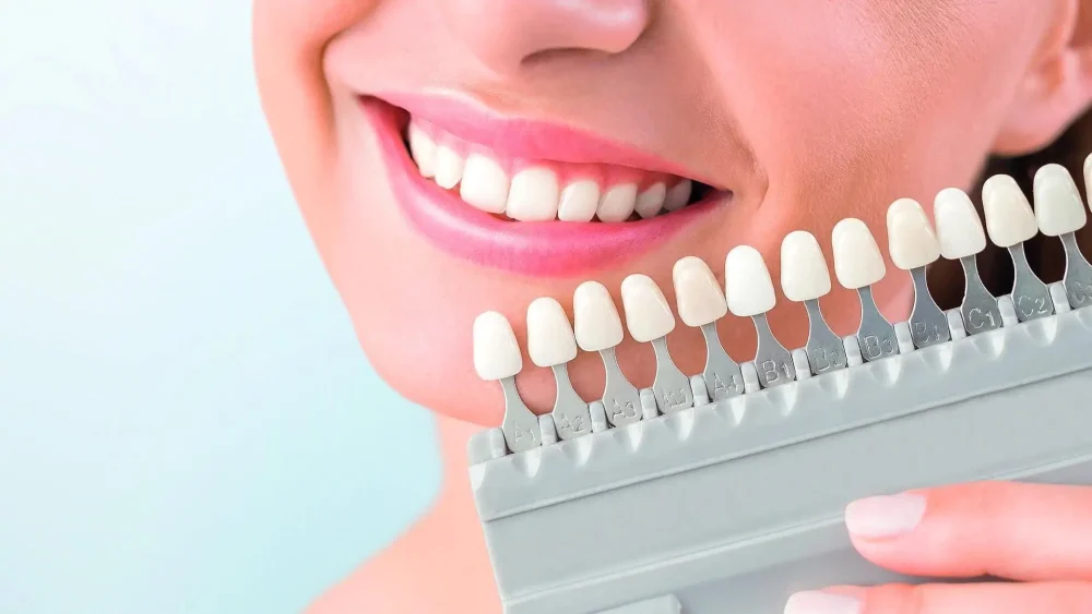 Πόσος χρόνος διαρκεί η λεύκανση των δοντιών;