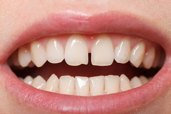 Πώς το Σύνθετη Συγκόλληση μπορεί να διορθώσει τα στραβά δόντια