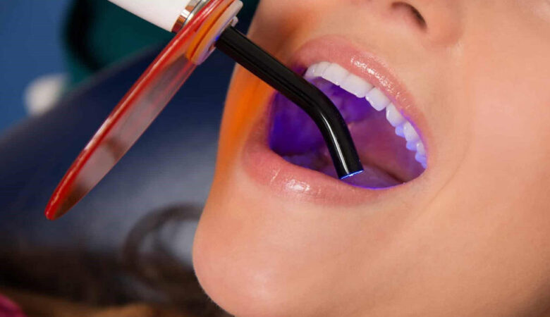 Τι είναι η σύνθετη οδοντική συγκόλληση;