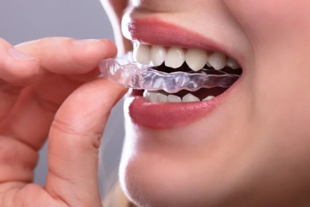 Γιατί να επιλέξετε μόνιμες οδοντιατρικές γέφυρες για αντικατάσταση δοντιών;