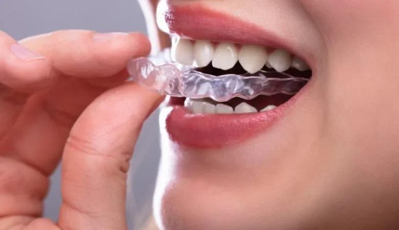 Γιατί να επιλέξετε μόνιμες οδοντιατρικές γέφυρες για αντικατάσταση δοντιών;