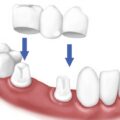 Γιατί οι οδοντικές στεφάνες χρειάζονται αντικατάσταση;