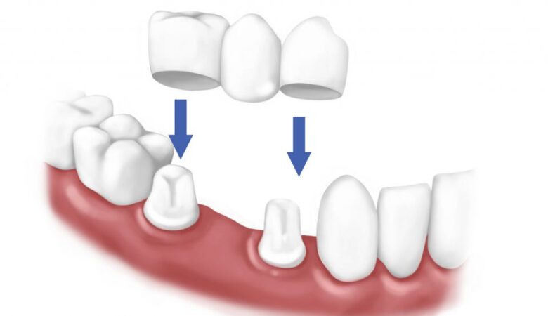 Γιατί οι οδοντικές στεφάνες χρειάζονται αντικατάσταση;